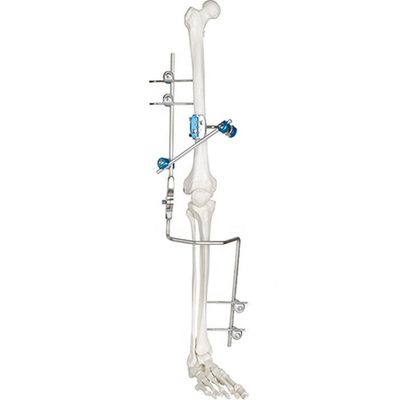Strumenti chirurgici ortopedici esterni medici del dispositivo di fissazione del giunto di ginocchio