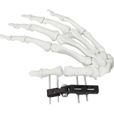 Dispositivo chirurgico ortopedico di Mini Fragment Ilizarov External Fixation